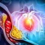 High Cholesterol: 6 Ayurvedic Herbs That Can Help To Open Closed Veins And Control Bad Cholesterol