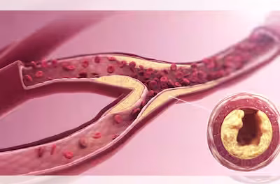 Morning Stroke Symptoms In Men: 7 Lifestyle Modifications To Prevent Wakeup Brain Stroke