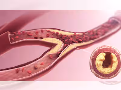 Morning Stroke Symptoms In Men: 7 Lifestyle Modifications To Prevent Wakeup Brain Stroke